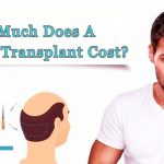 Factors affecting cost of hair transplant