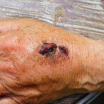 What are the different categories of open wounds and their treatment