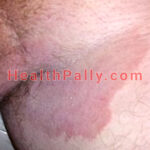 Chronic Jock Itch Causes, Symptoms & Natural Treatment/Cure/Remedy Causes of Jock itch, symptoms and treatment