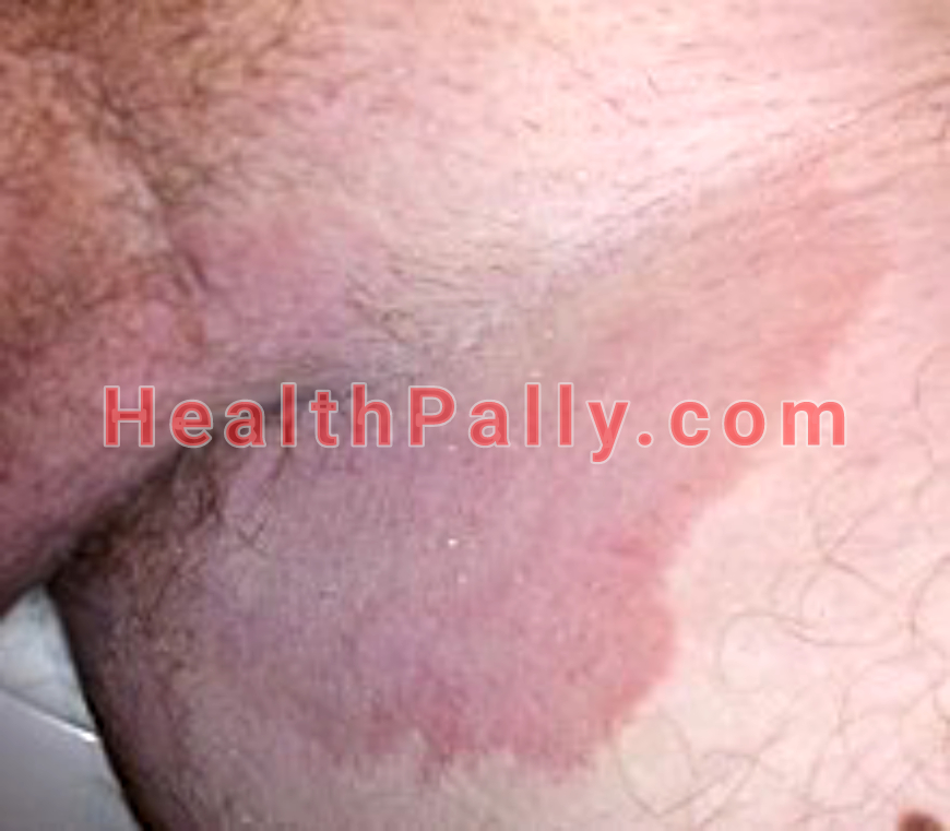 Causes of Jock itch, symptoms and treatment 