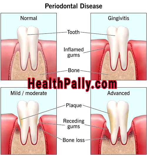 Periodontal diseases and treatment