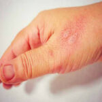 Inflammation - Causes, Stages, Symptoms and Effects Inflammation – Causes, Stages, Symptoms and Effects