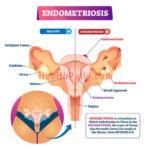 Endometriosis & Infertility in Women: Symptoms, Diagnosis and Treatment What is endometriosis and infertility