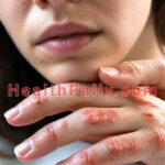 The Different Types of Eczema (Dermatitis) Factors responsible for dermatitis