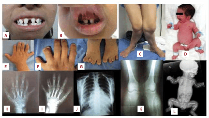 What is Ellis Van Creveld Syndrome 
