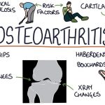 Types of Osteoarthritis, symptoms and treatment