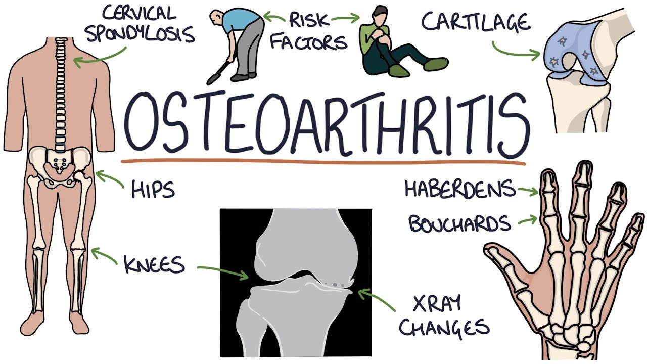 Types of Osteoarthritis, symptoms and treatment