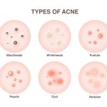 Different types of acne and how to get rid of them