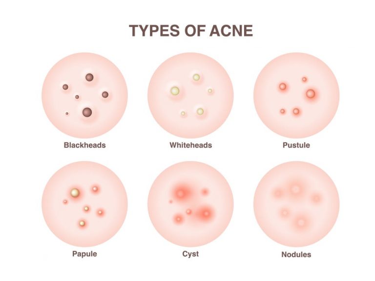 Different types of acne and how to get rid of them