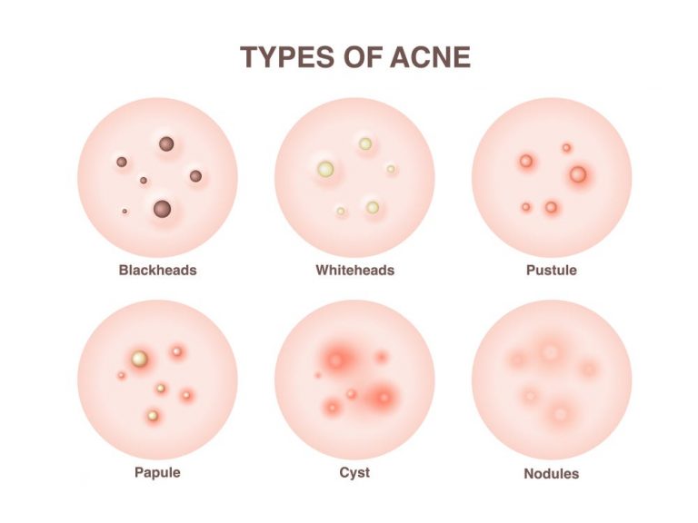 Different Types Of Acne Causes Symptoms And Treatments