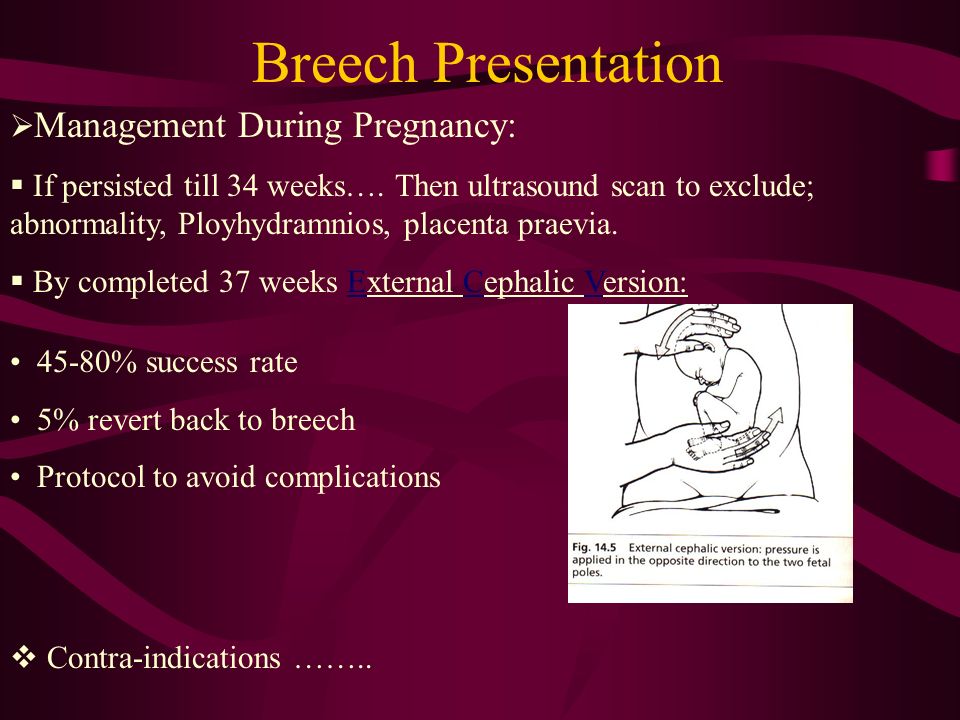 Breech position of fetus in pregnancy