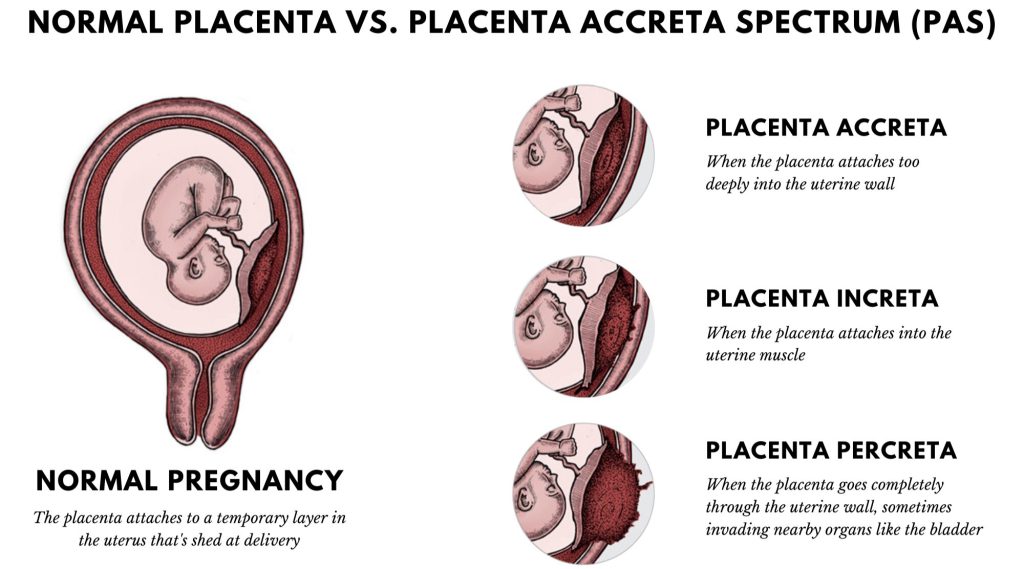 What is placenta accreta