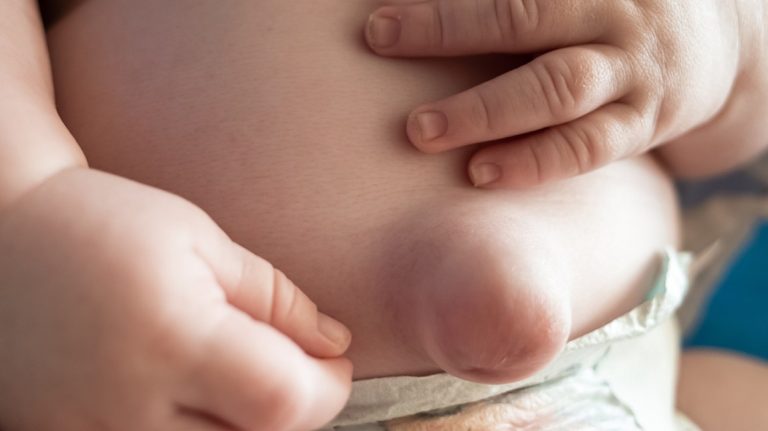How to prevent umbilical hernia in babies