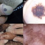 Genital melanosis vs melanoma