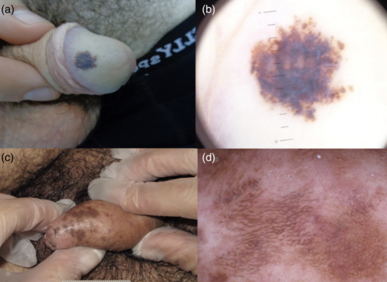 Genital melanosis vs melanoma