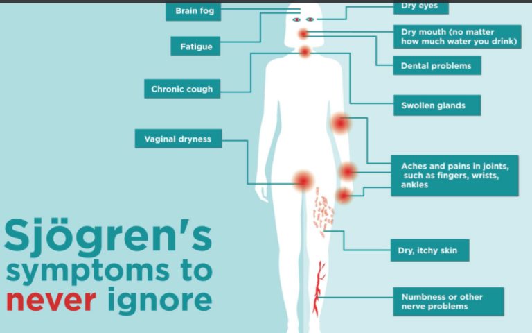 sjogren's syndrome diagnosis and treatment